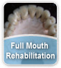 Full Mouth Rehabilitation Full Mouth Rehabilitation