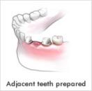 Adjacent Teeth Prepared