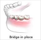 Bridge in Place
