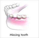 Mising Tooth