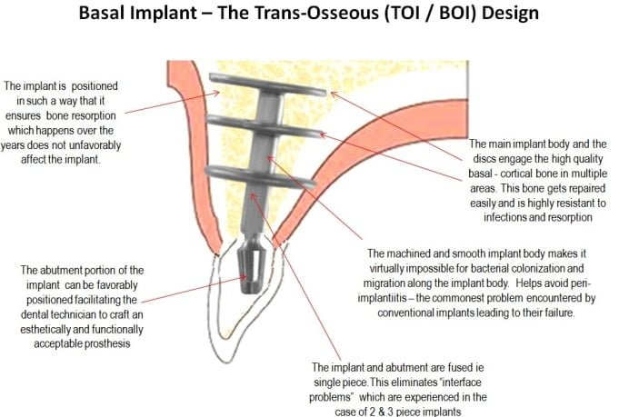 Immediate Loading Basal Dental Implant Treatment Clinic In Delhi India 