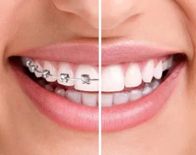 Adult Dental Braces