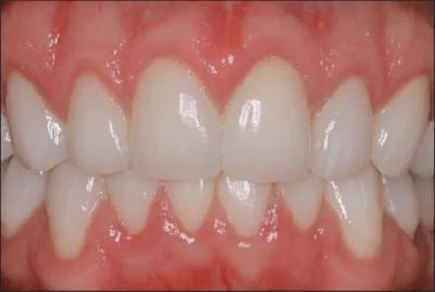 Full Mouth Rehabilitation