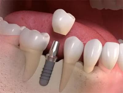 Dental Implants Treatments