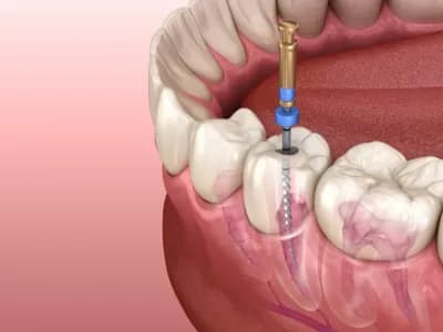 Root Canal Treatment (RCT)