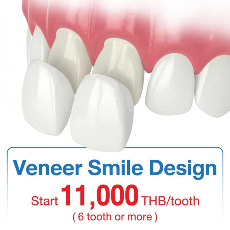 Veneer Smile Design