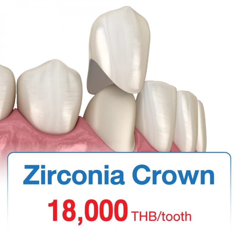 Zirconia Crown