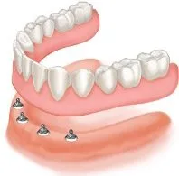All On 4 Dental Implant