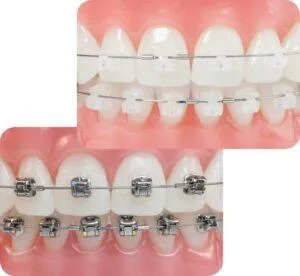 Invisible Tooth Coloured Painless Dental Braces Treatment in Delhi.