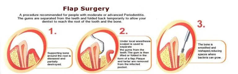 Periodontal-Flap-Surgery