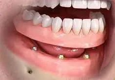Affordable full Jaw implant retained dentures