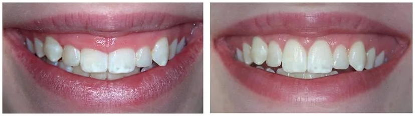 Gummy-Smile