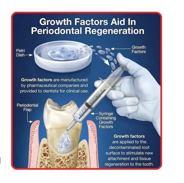 Periodontal-Flap-Surgery-Regeneration