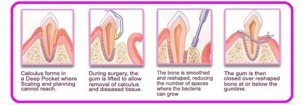 Periodontal-Flap-Surgery-Treatment