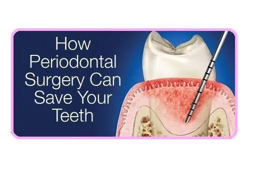 Periodontal-Flap-Surgery-save-teeth