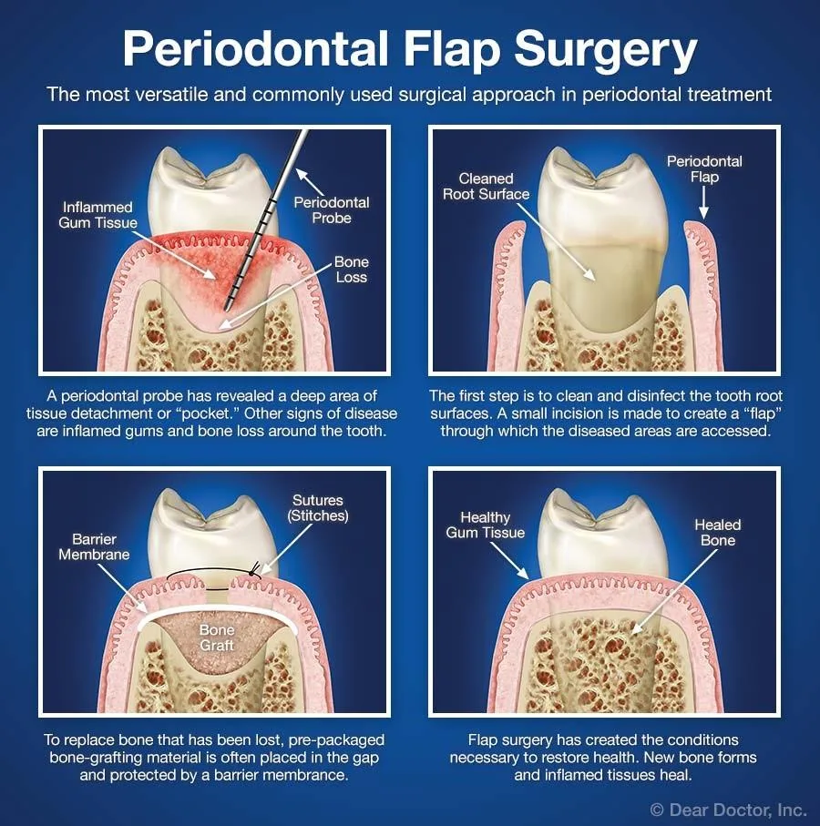 Periodontal-Flap-Surgery