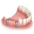 2nd visit : Multiple dental implant surgical procedure.