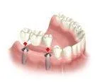 3rd visit : Dental impressions and trials.
