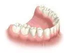 4th visit : Dental implant supported fixed bridge placement.