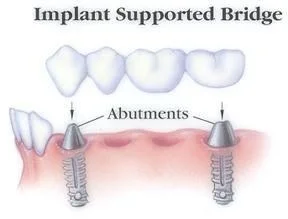 Dental Implant Bridge Treatment