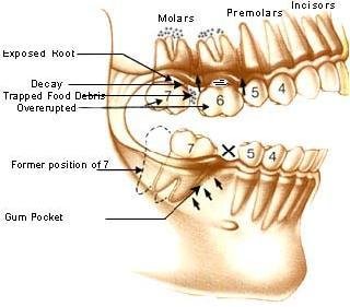 Why replace a missing tooth?
