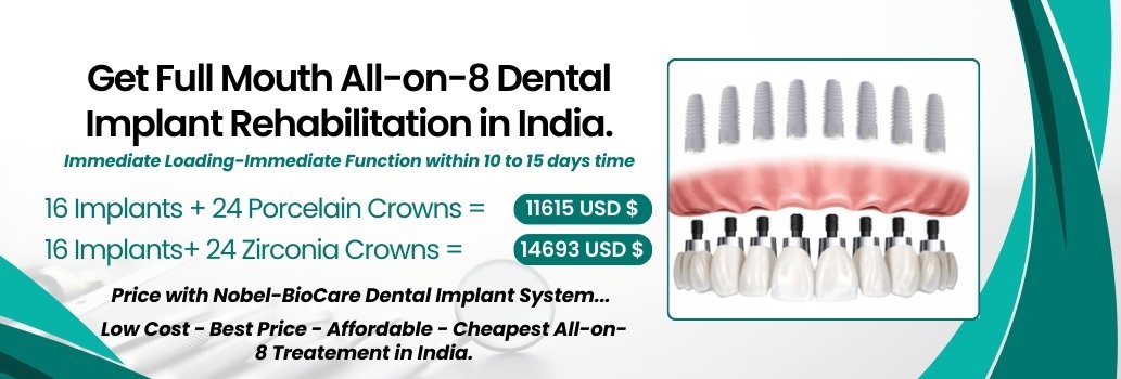 All on 8 Nobel Implant