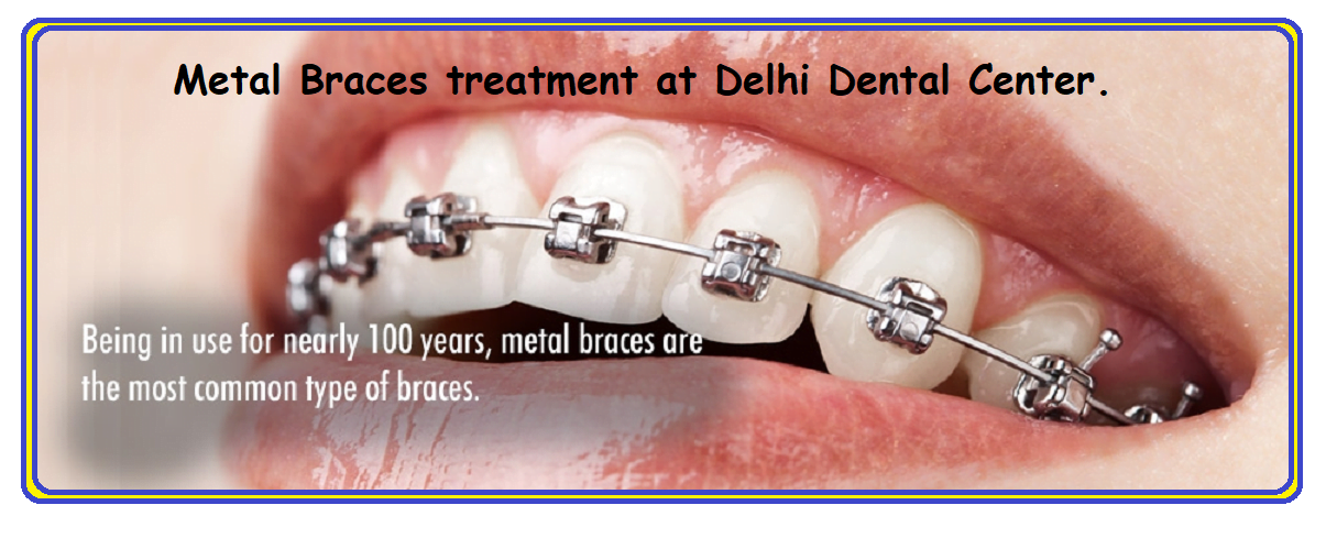 Metal Braces Treatment Delhi