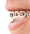 type of Orthodontic Braces treatments