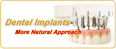 Dental Implants - A More Natural Approach