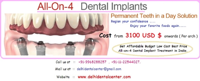All on 4 Implants Delhi