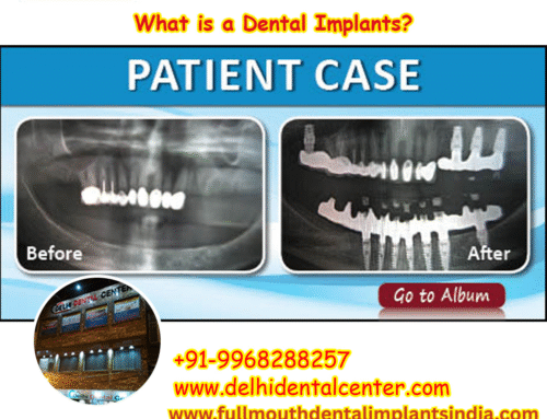What is a Dental Implants? 