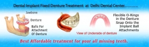 Dental Implant Fixed Denture