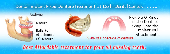 Dental Implant Fixed Denture Delhi India