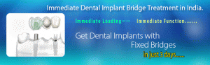 Immediate-Dental-Implant