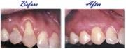 Gingival Graft Treatment