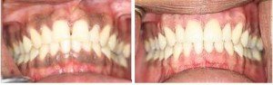 Depigmentation of Gums Treatment