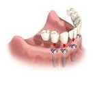 Installing the Dental Implant