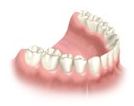 Dental Implant Bridge placement