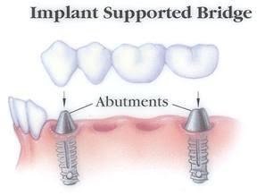 implant-supported-bridge in delhi