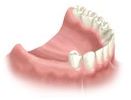 Examination and X-Rays for dental implant