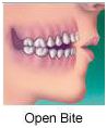 Orthodontic and Dental Braces Treatment Delhi India