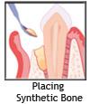 Placing Synthetic Bone
