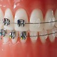 Orthodontic Braces treatments Delhi India