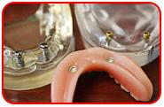 Dental Implant Supported Overdentures and Fixed Overdentures