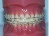 Orthodontic Braces treatments Delhi India