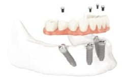 dental implants india