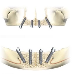 All-on-4 Dental Implant Delhi India