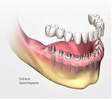 dental implant