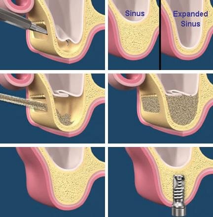 Sinus Lift Procedure Delhi India