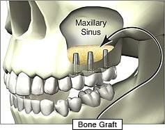 Sinus Lift Procedure Delhi India